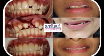 faulty bite upper arch ectopic canine smile correction with zirconia crwn's with pink gingival
